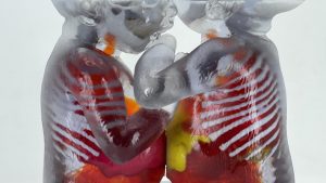 Lee más sobre el artículo Dos siamesas separadas con éxito gracias a la tecnología 3D